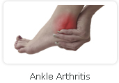 Ankle Arthritis - Victorian Orthopaedic Foot & Ankle Clinic